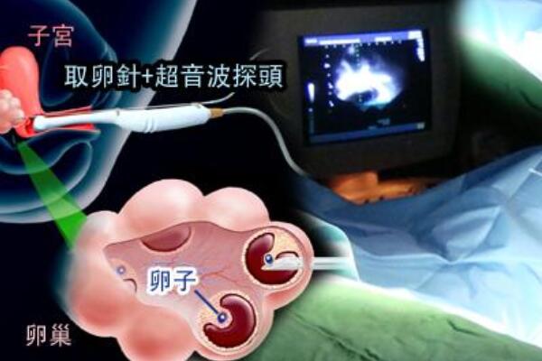 妇女做供卵试管婴儿要去几次医院？