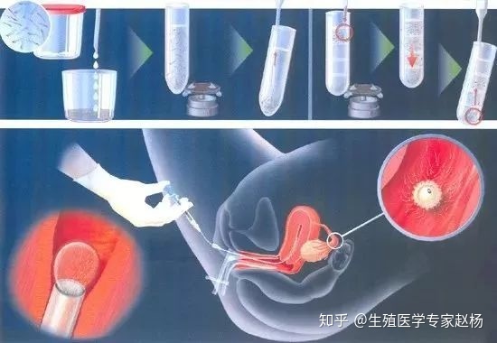 做供卵私立代怀试管取卵手术要不要麻醉？