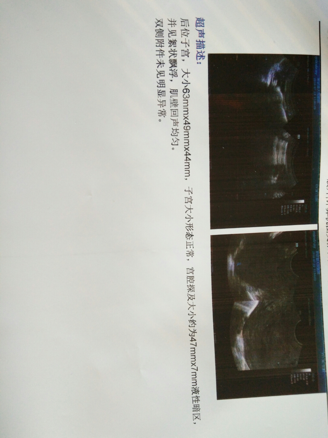 结扎后还能做供卵试管婴儿吗